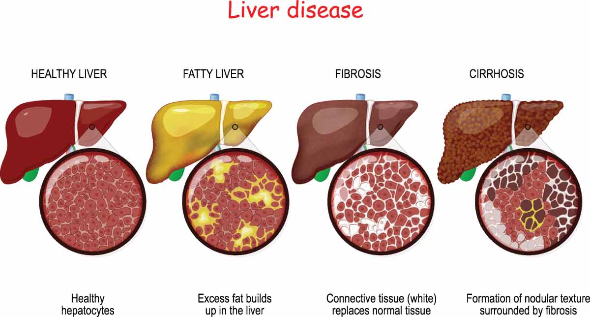 liver diseases and stages of liver disease