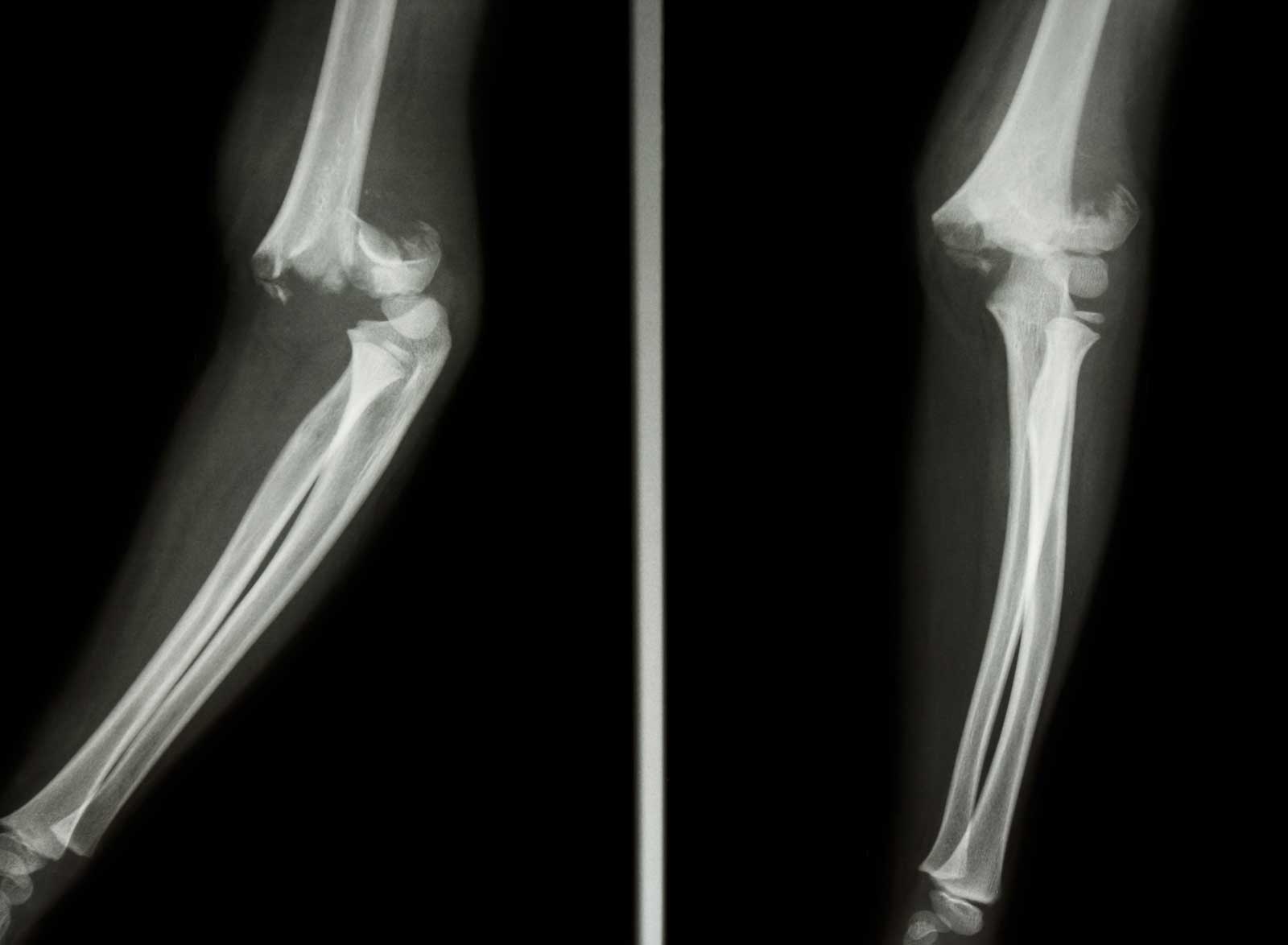 supracondylar humerus fracture