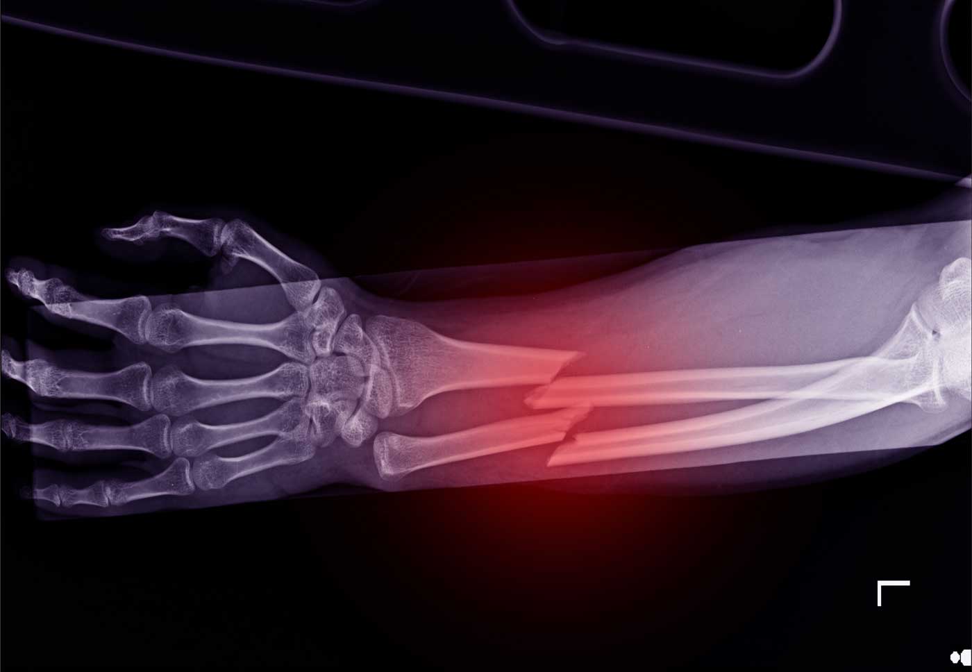 X-ray forearm fracture radius and ulnar bone