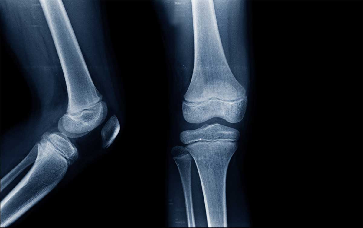 X-ray of child's knee