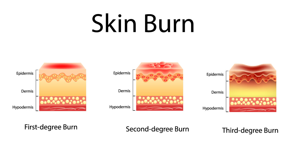 three degrees of skin burns
