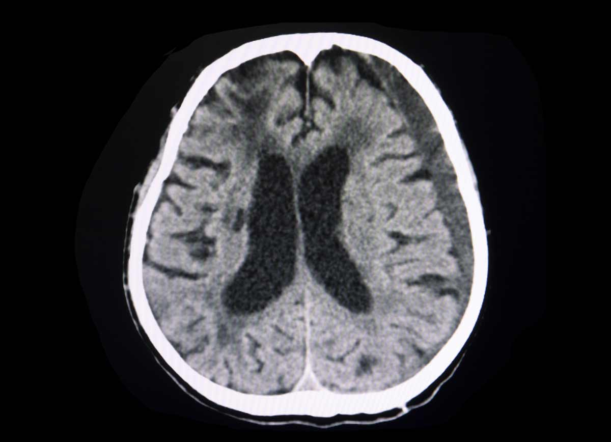 CT brain in trauma patient with subacute subdural hematoma