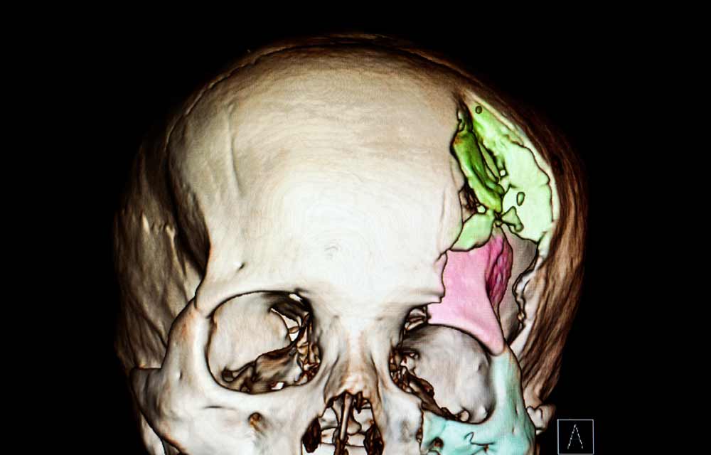 CT image of skull of a patient with severe depression skull fractures