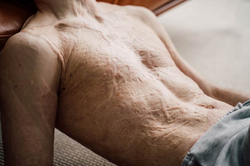 man with large scar after burn on body