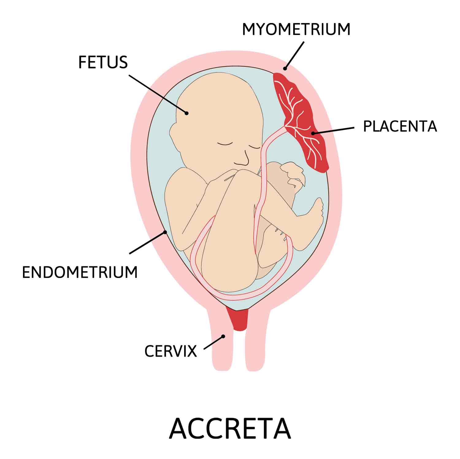 Placenta accreta grades of abnormal attachment illustrated according to depth
