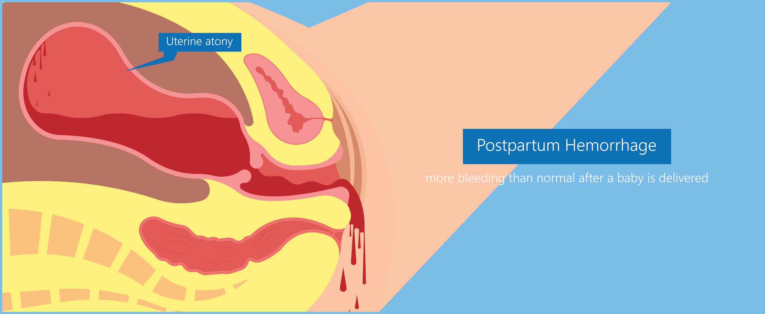 Postpartum hemorrhage PPH care