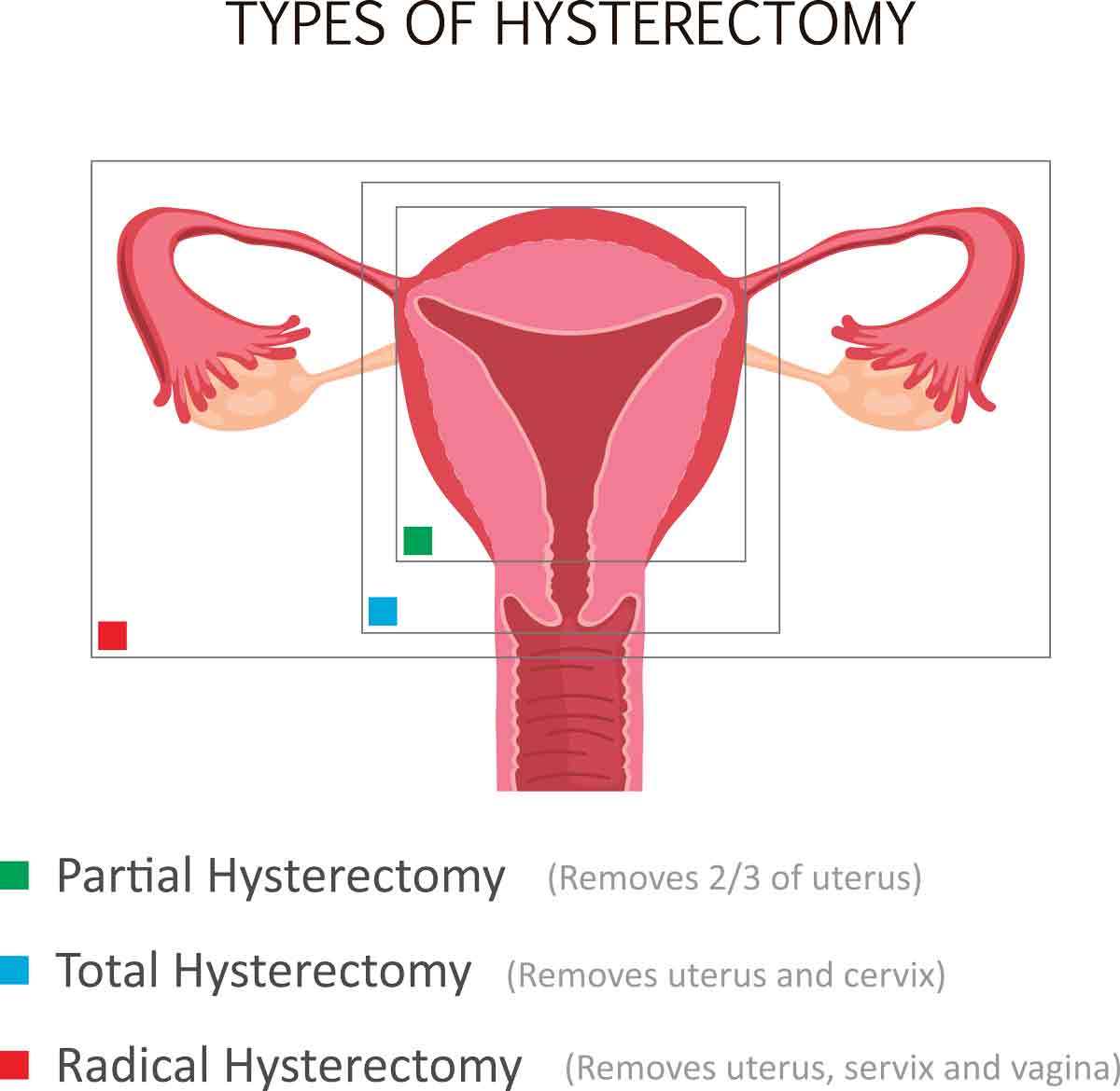 Types of Hysterectomy  - Partial, Total and Radical