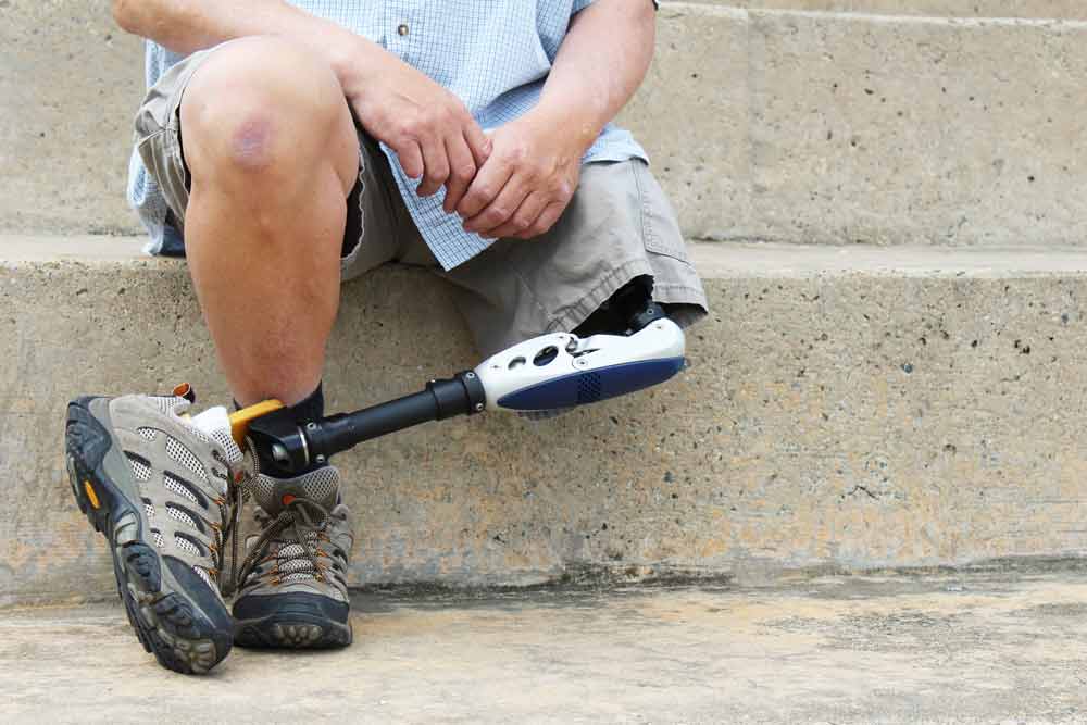 amputee with prosthetic legs crossed