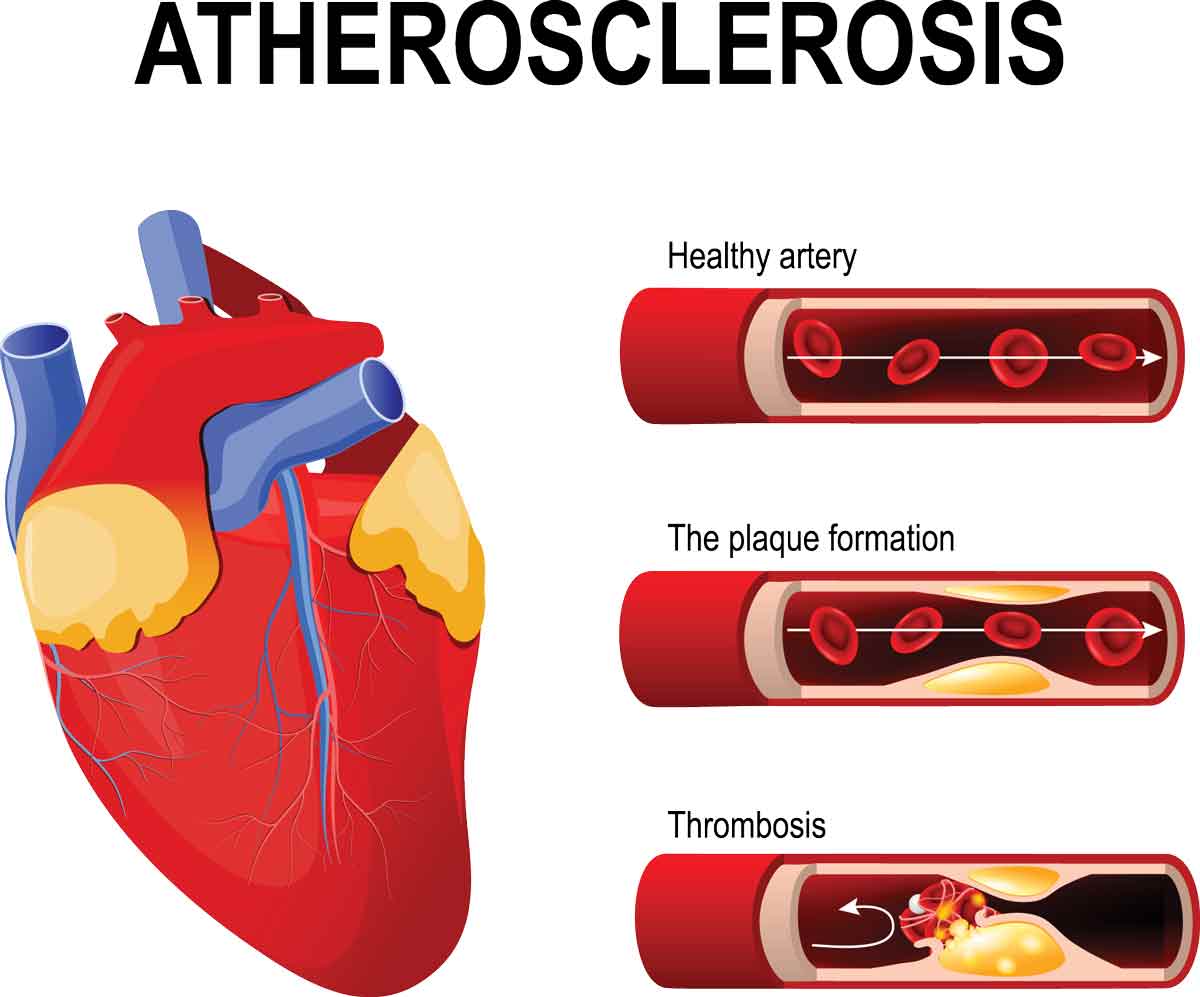 atherosclerosis stages