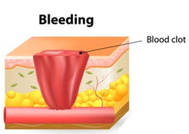 bleeding stage of wound healing