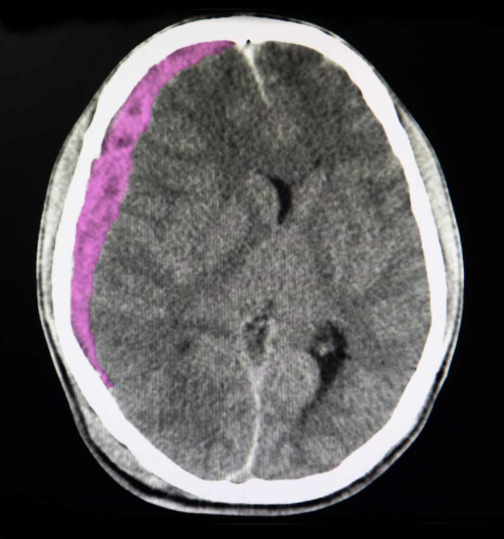 Brain CT scan shows acute subdural hematoma