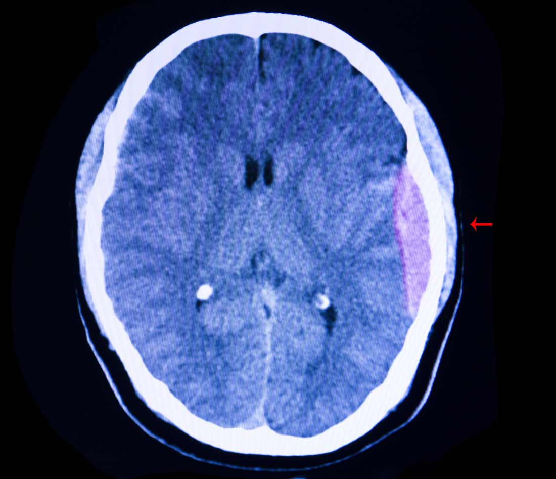 brain CT scan shows epidural hematoma