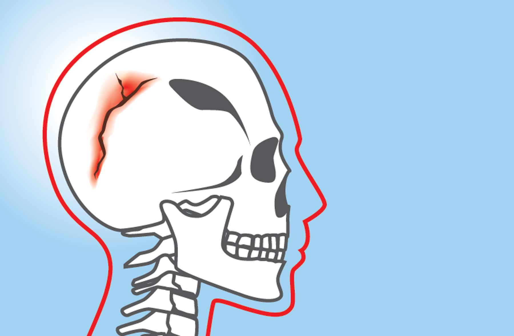 break in cranial bone or skull fracture