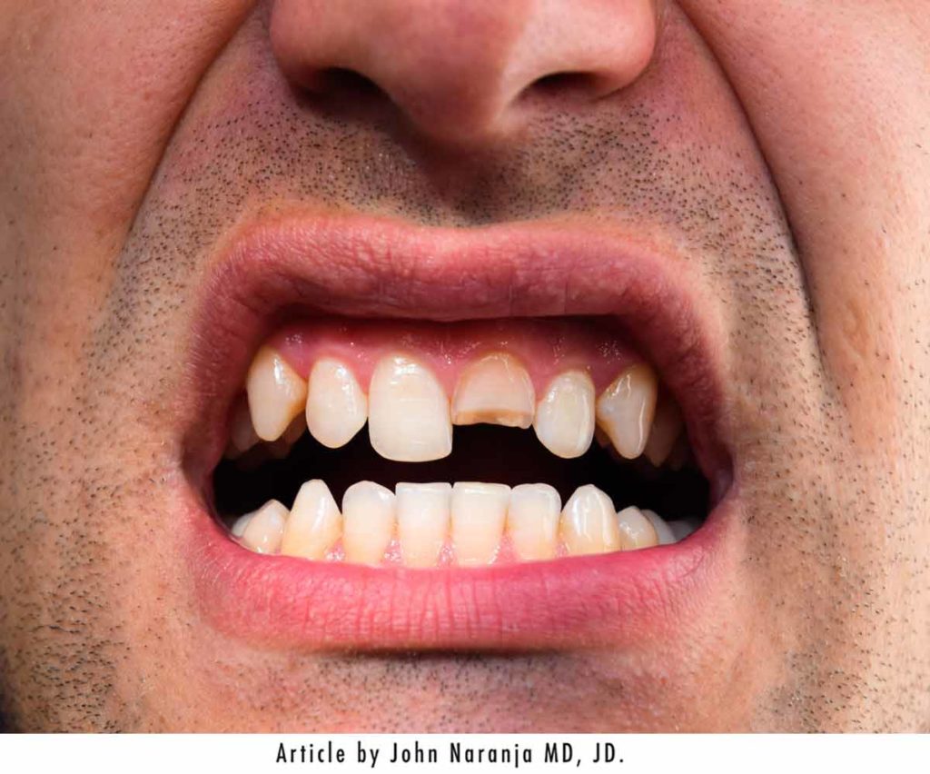 broken tooth - upper incisor in man's mouth