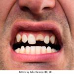 broken tooth - upper incisor in man's mouth