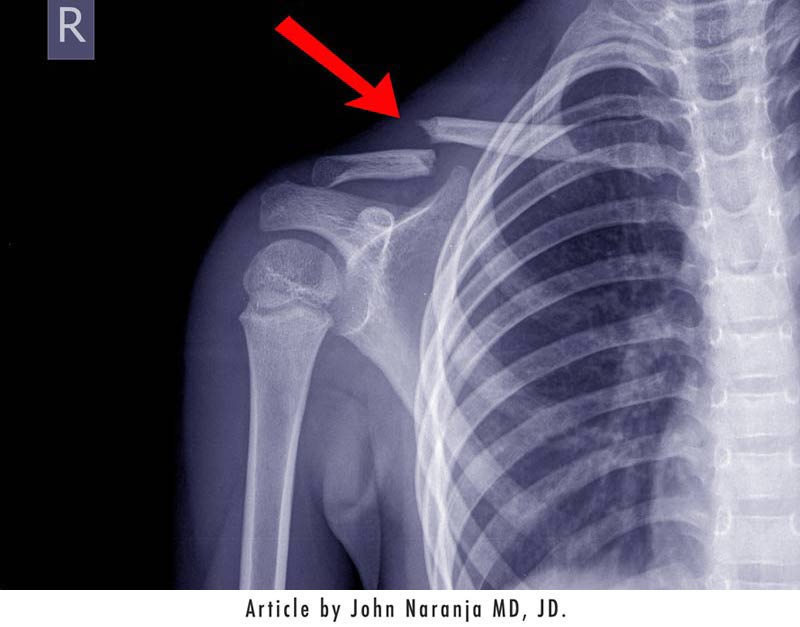 chest x-ray fracture right clavicle - article by john naranja md jd