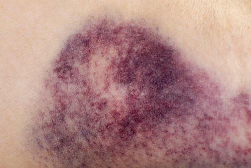 closup of hematoma on woman's arm