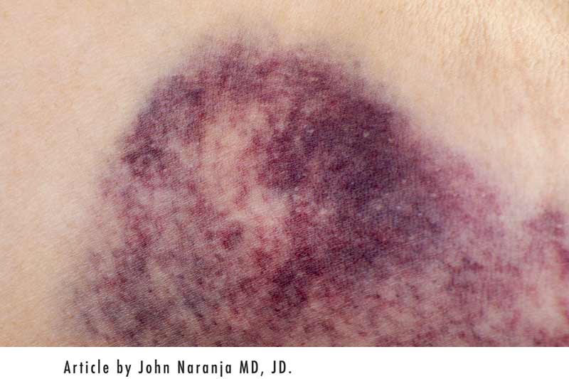 photo of hematoma on arm - article by Dr. John Naranja, MD, JD