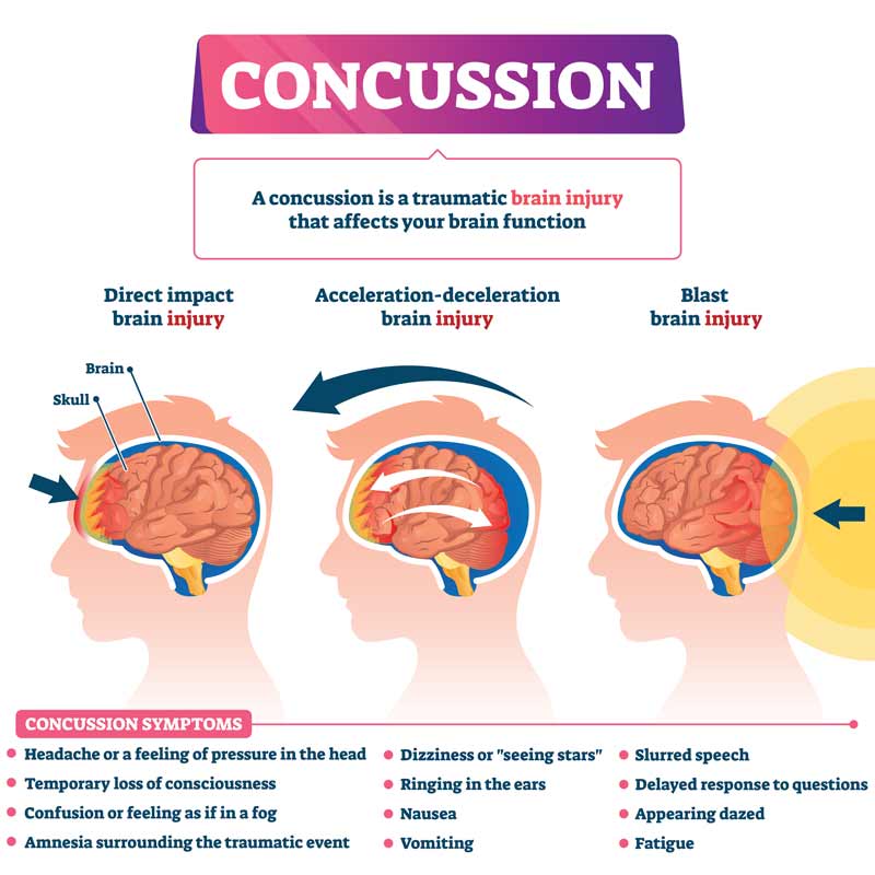 concussion illustration of head trauma