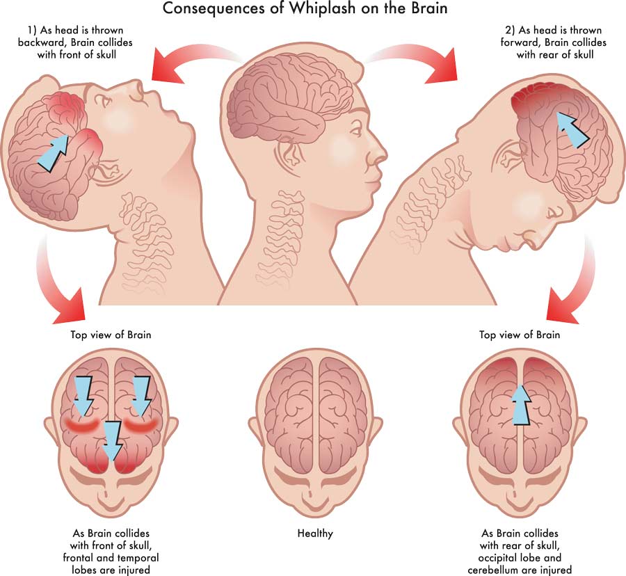 consequences of whiplash on the brain