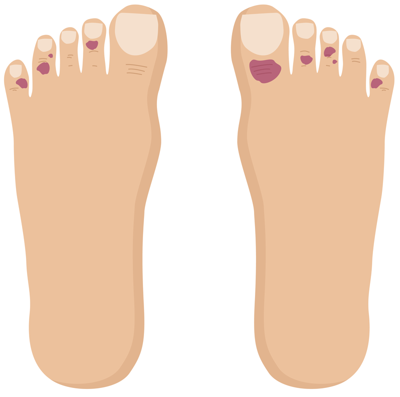 covid toes are caused by COVID-19 virus