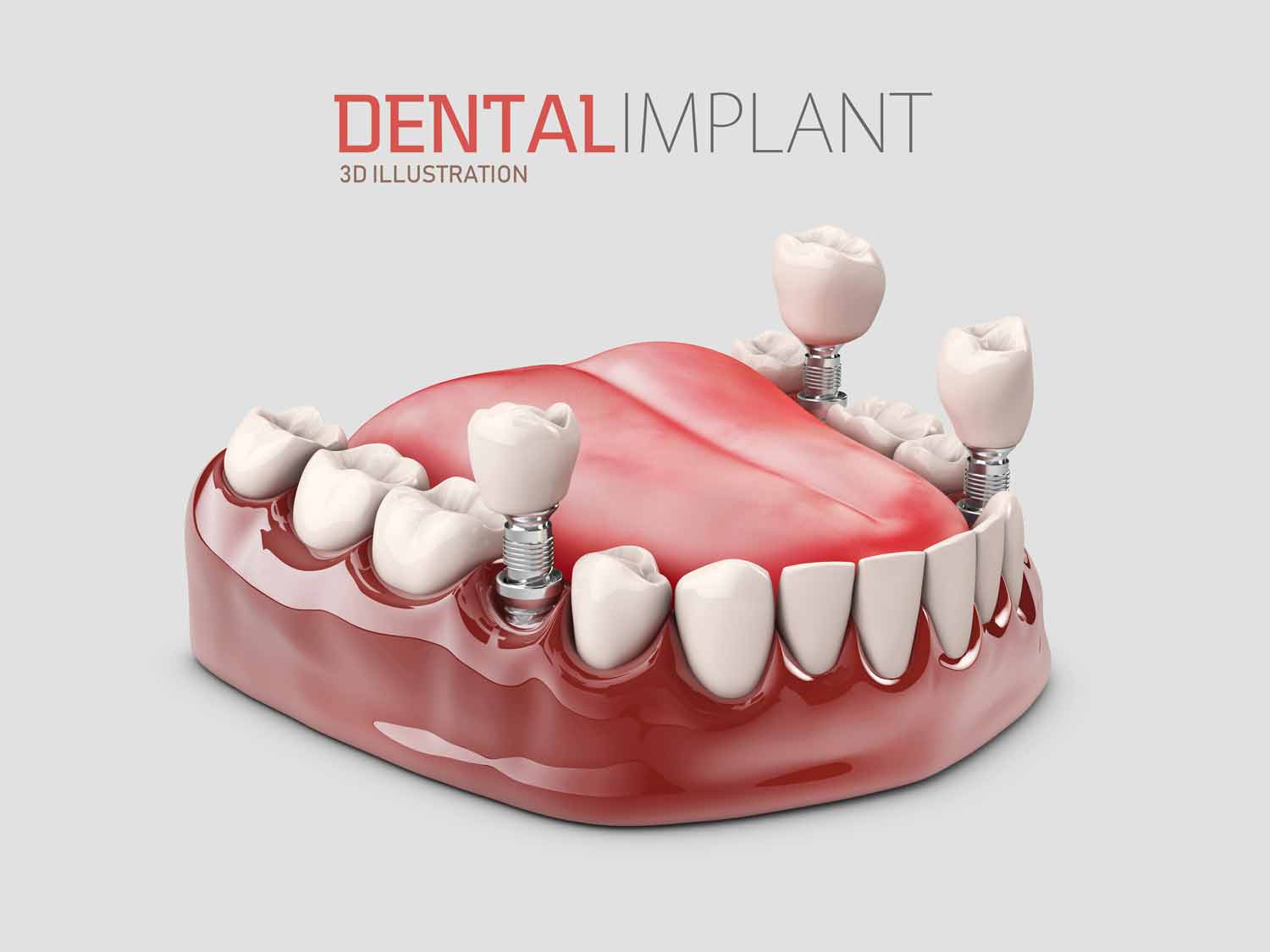 dental implant