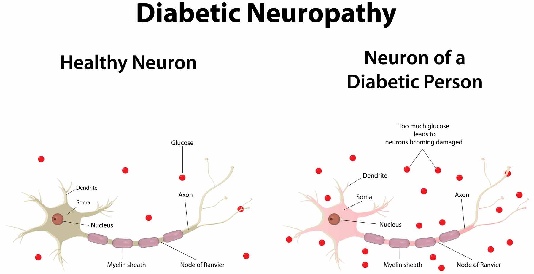 normal neuron and diabetic neuropathy 