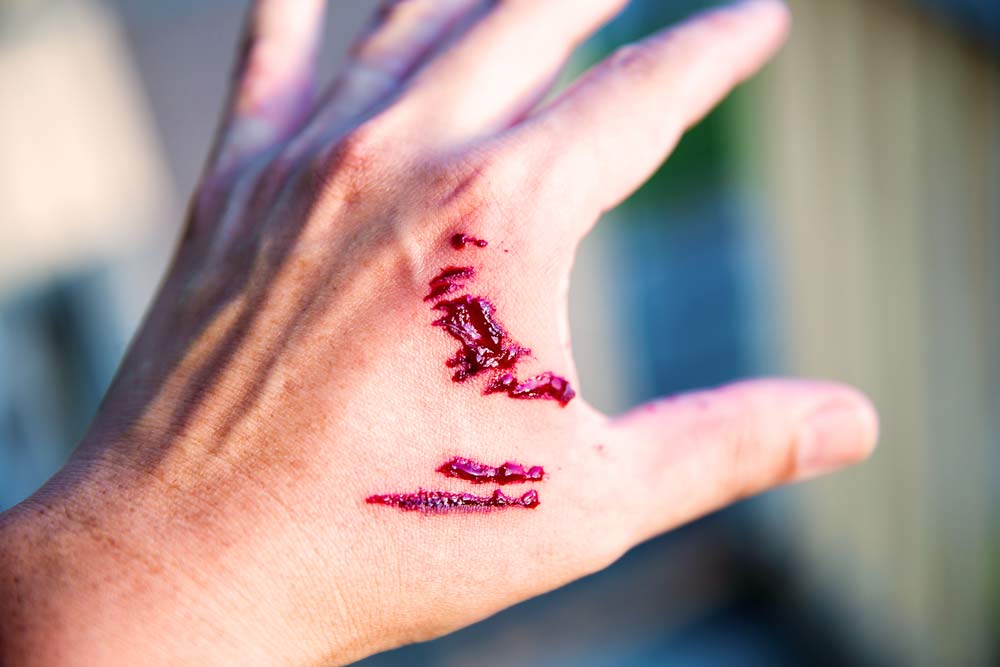 dog bite wound on hand with blood