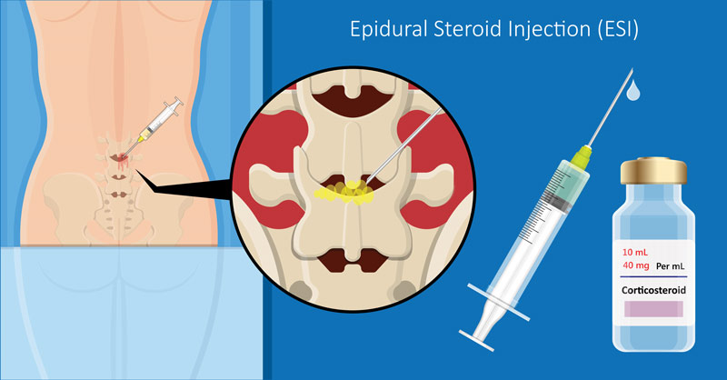 cortisone shots - epidural steroid injection