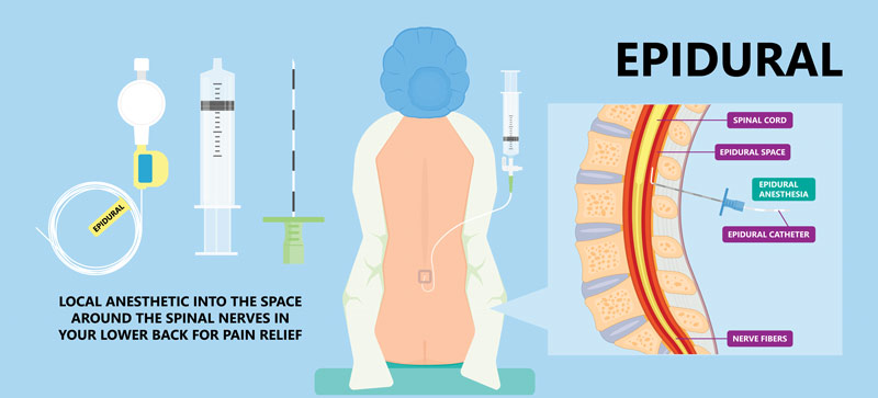 epidural steroid injection iillustration