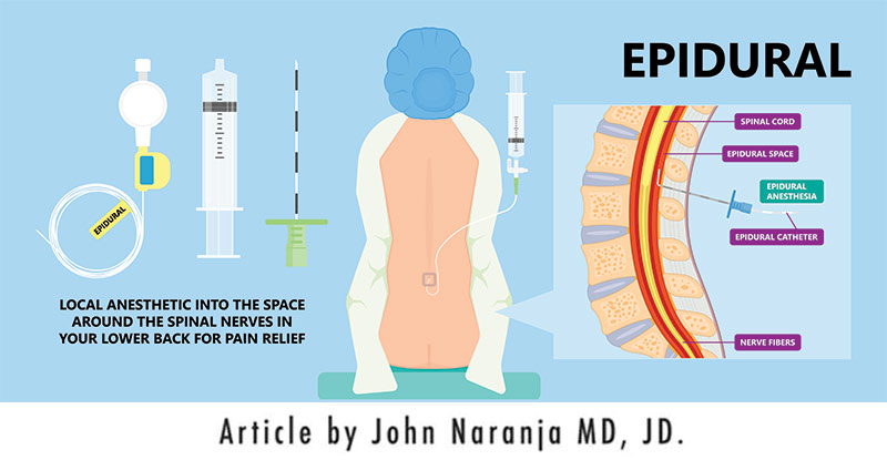 epidural steroid injection iillustration