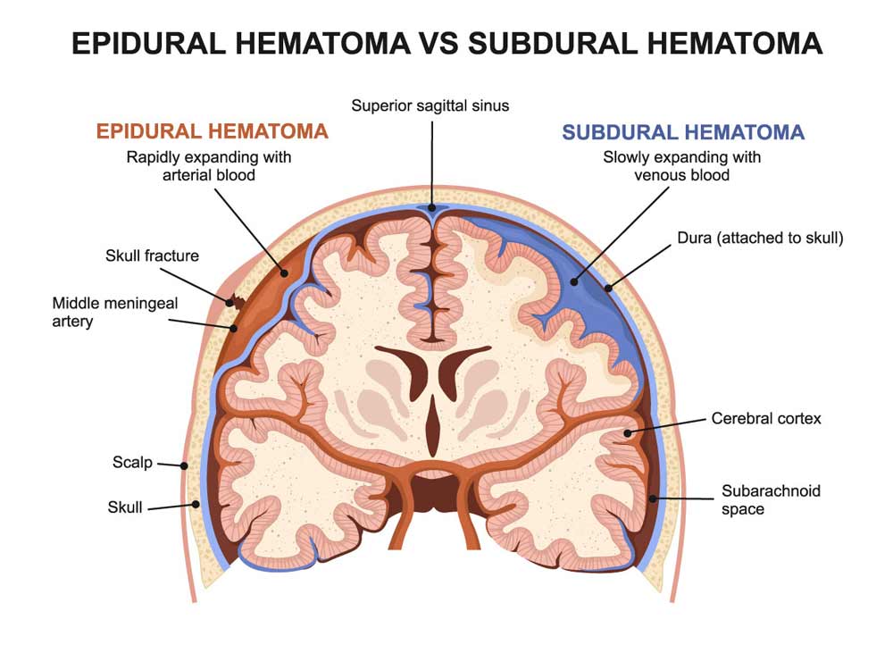 epidural hematoma vs subdural hematoma