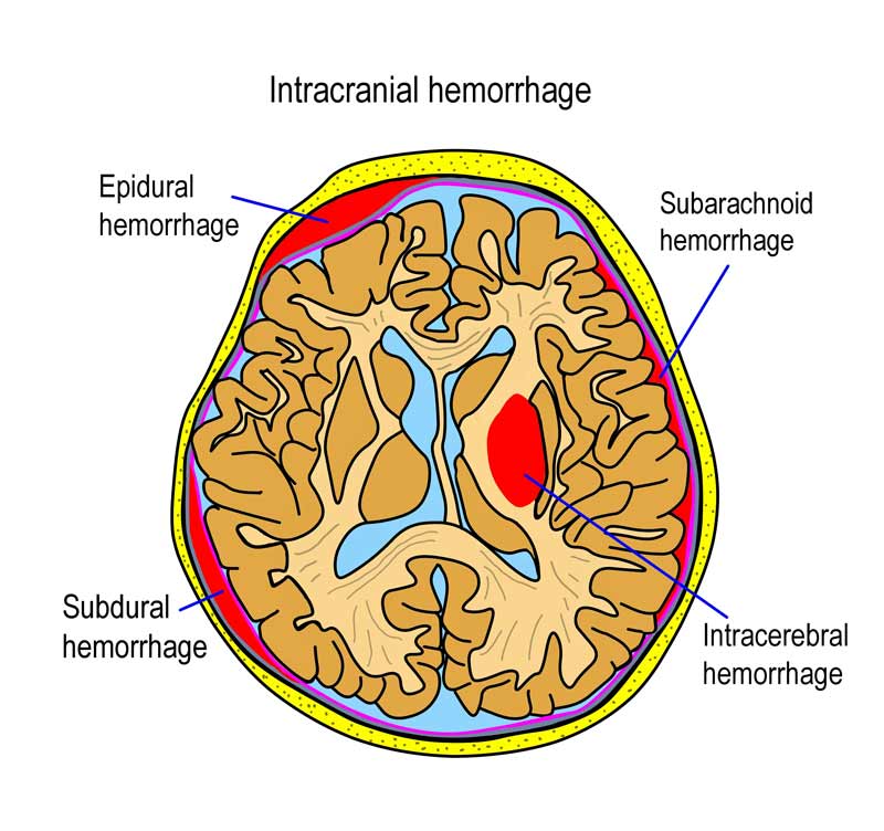 Four types of intracranial hemorrhage