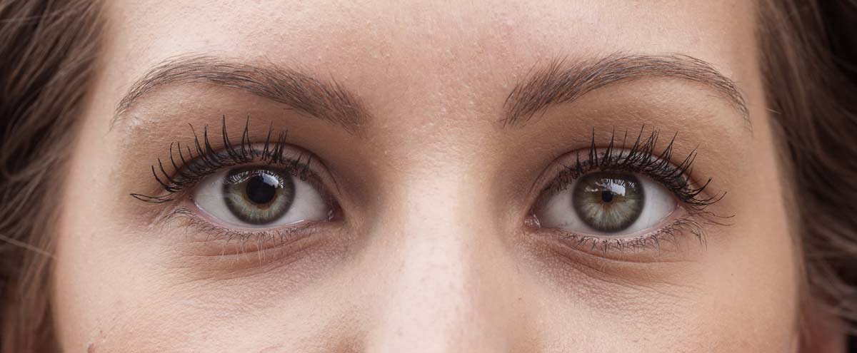 girl with one pupil larger than the other. A common condition called anisocoria