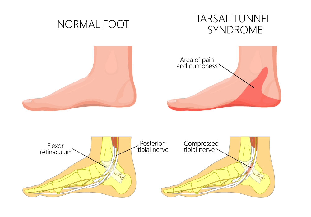 healthy foot versus medial axle injury call tarsal tunnel syndrome