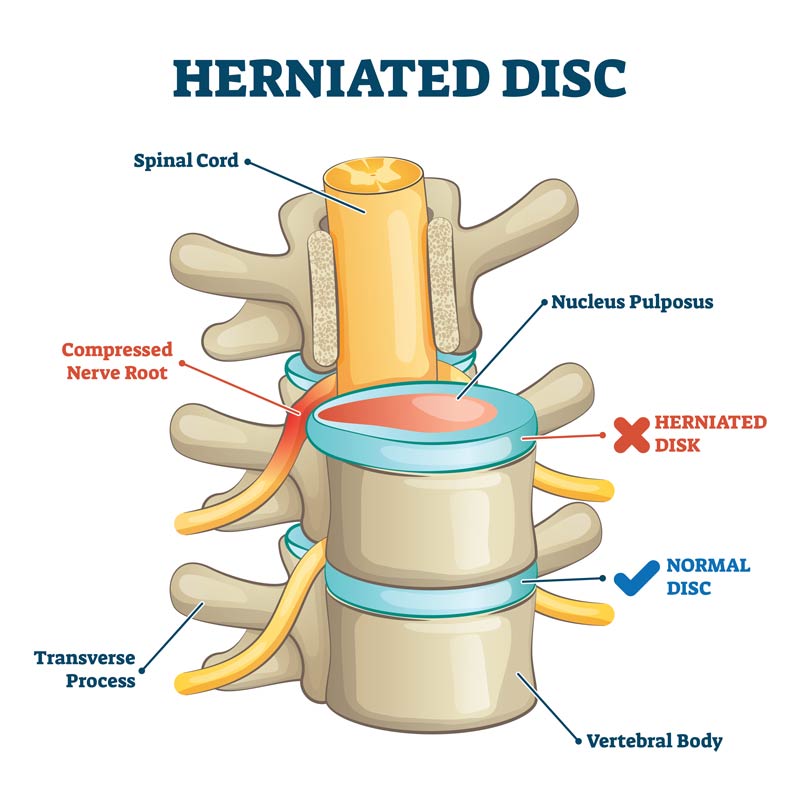 herniated disc 3d side view