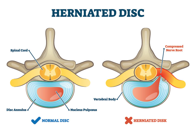 herniated disc injury