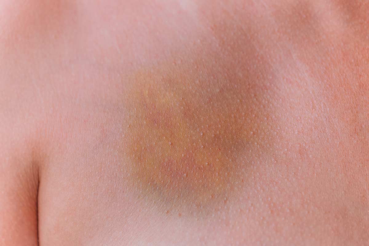 Closeup view of huge yellow, red and blue bruise on chest