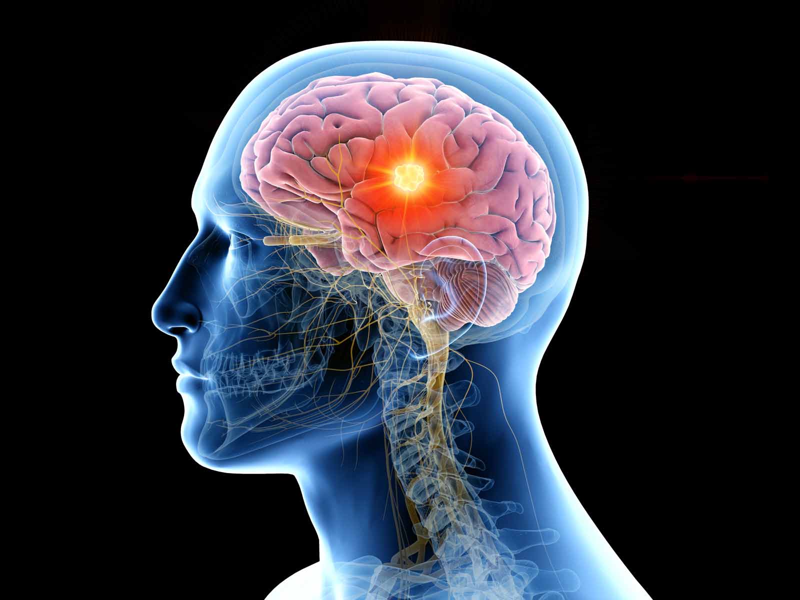 brain illustration showing brain tumor 
