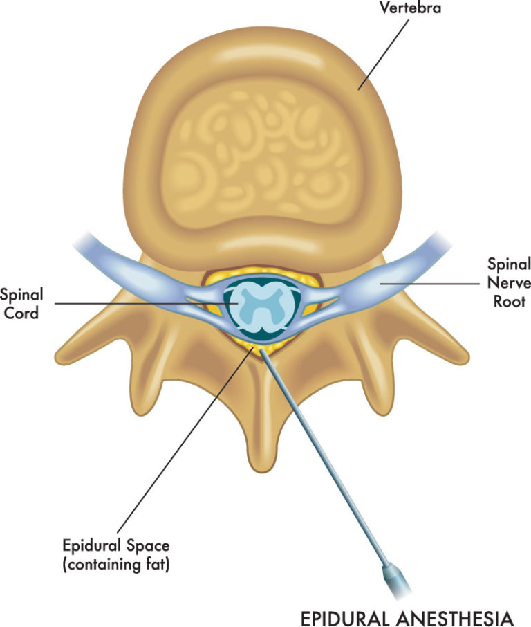 Ask Dr John Esq. What Are Epidural Steroid Injections? Diller Law