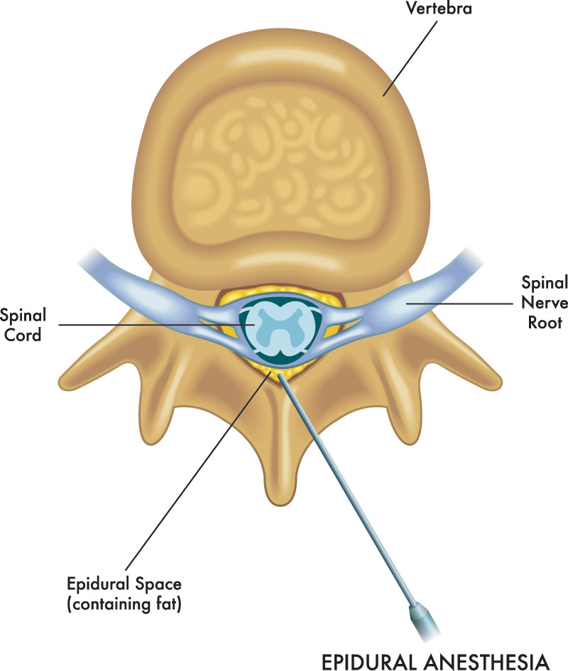 illustration of medical injection for epidural anesthesia 