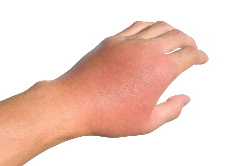 inflammation, swelling, and redness of the infected hand