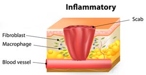 inflammatory stage of wound healing