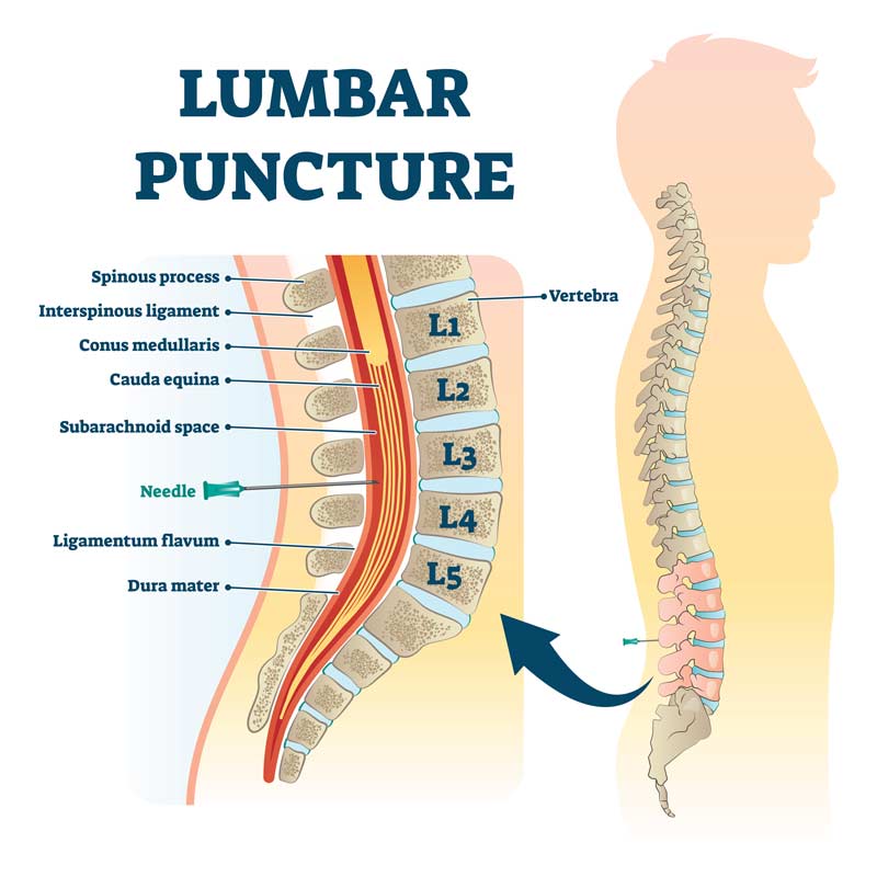 lumbar puncture vector illustration with labeled spine structure.