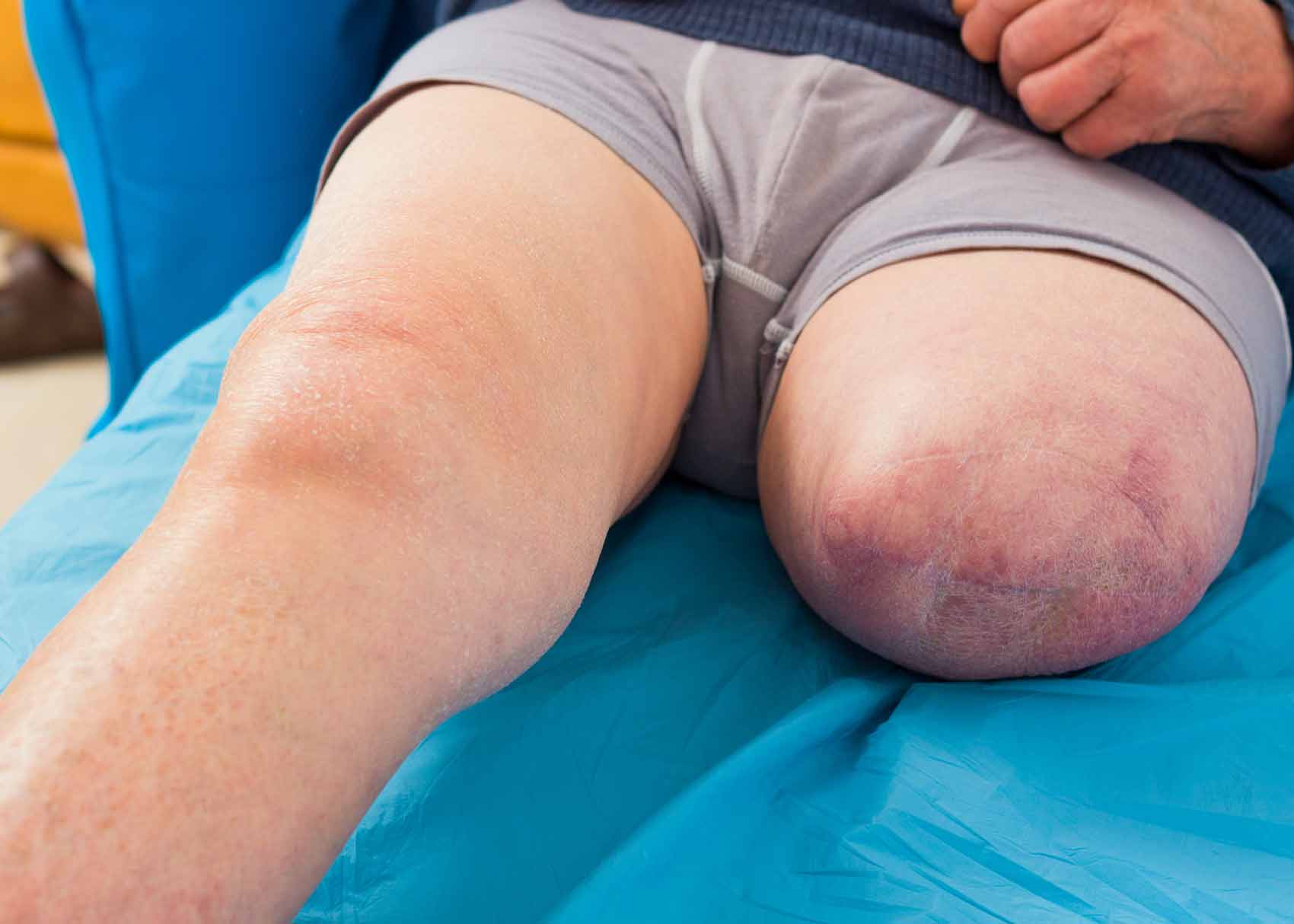 man with amputated leg