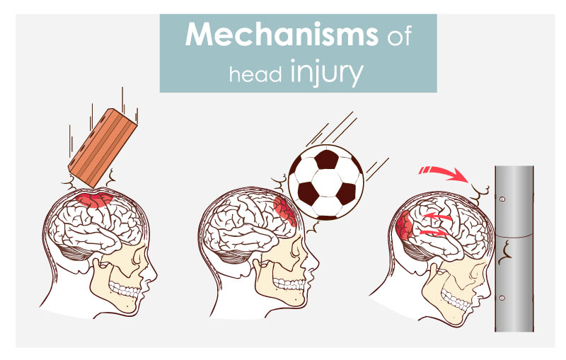 mechanisms of head injury and concusion