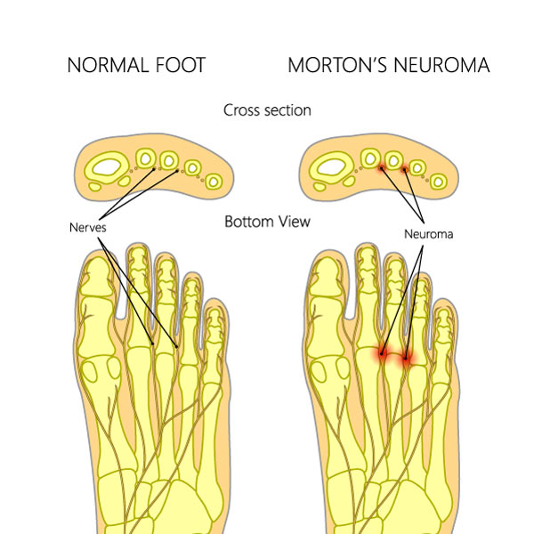 morton's neuroma is an inflammatory condition caused by shingles