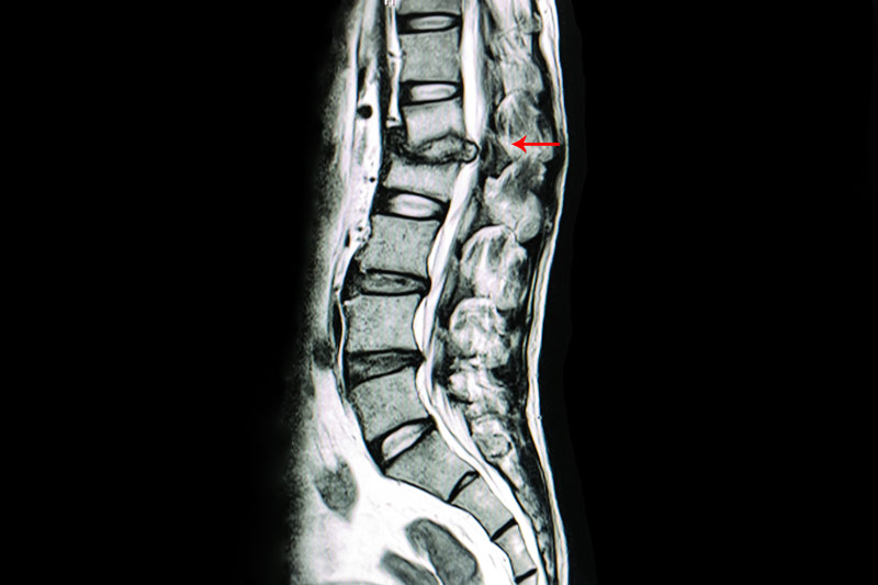 mri scan of spine shows herniated disc