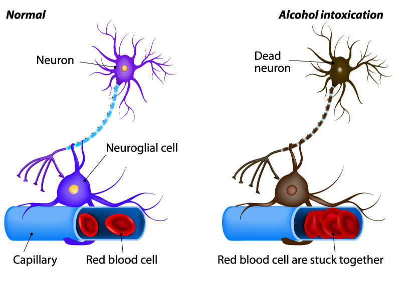 nerve damage caused by heavy alcohol intoxication is more common cause of nerve damage