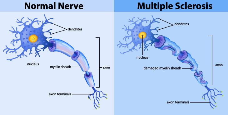 normal nerve and multiple sclerosis nerve